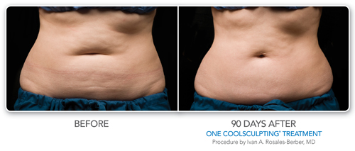 CoolSculpting® - Cumberland Laser Clinic