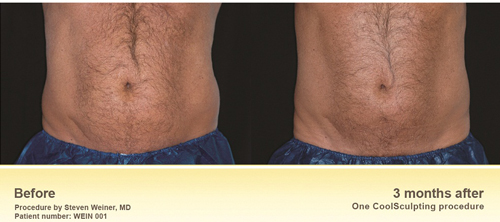 CoolSculpting® - Cumberland Laser Clinic