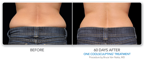 CoolSculpting® - Cumberland Laser Clinic