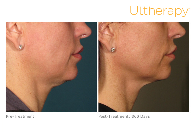 Ultherapy® - Cumberland Laser Clinic