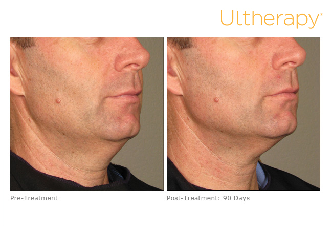 Ultherapy® - Cumberland Laser Clinic