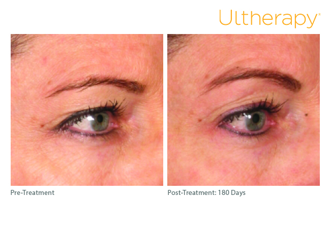 Ultherapy® - Cumberland Laser Clinic