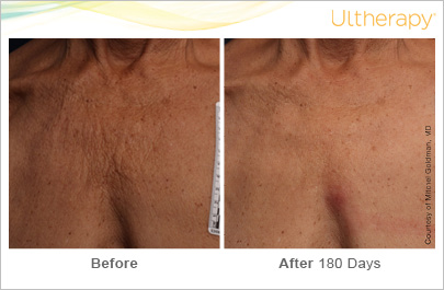 Ultherapy® - Cumberland Laser Clinic